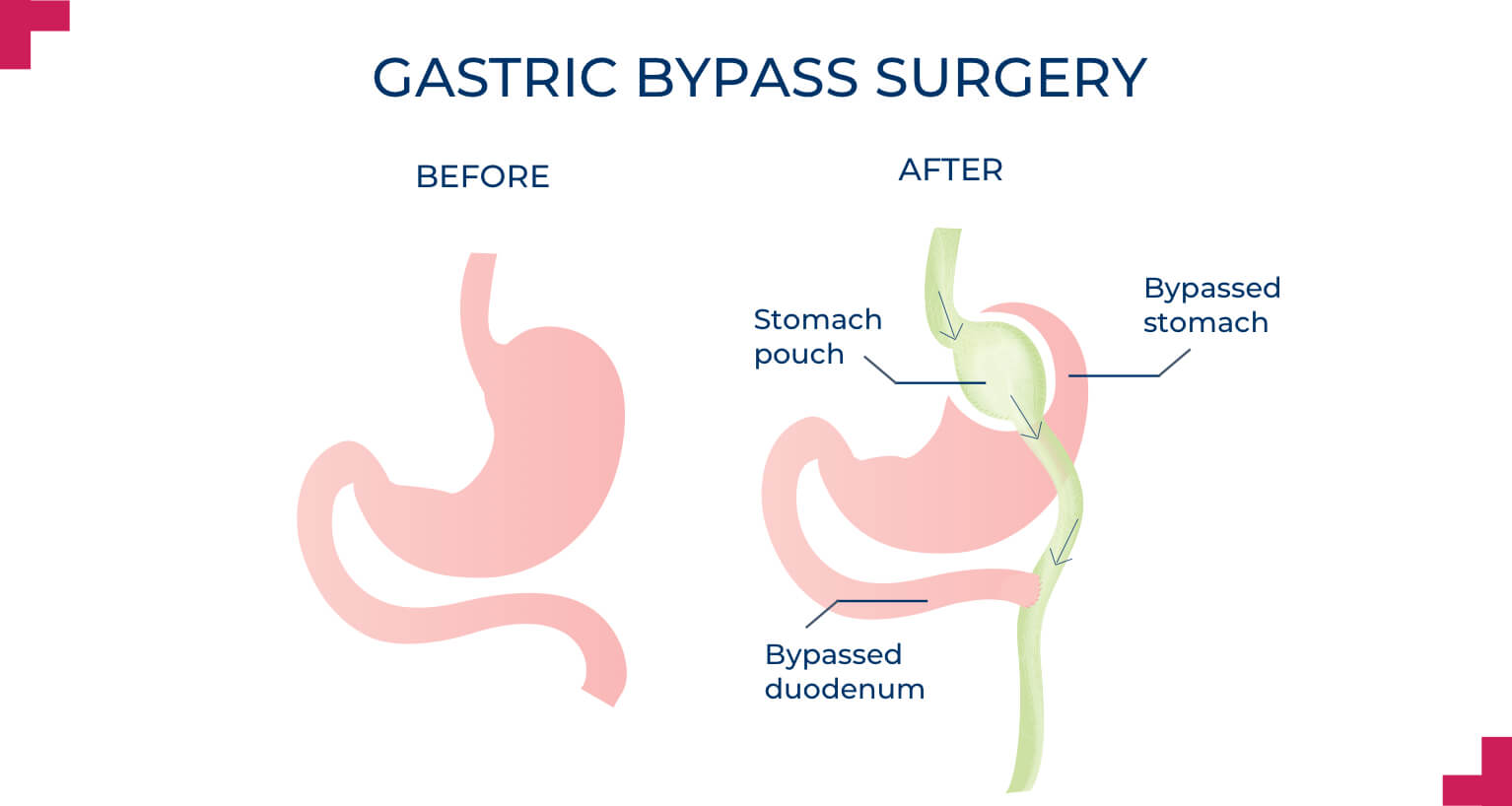 Gastric Bypass Surgery - roux-en-y