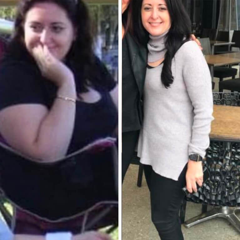 Marie Helene before and after Bariatric Surgery - Advance Surgical Perth